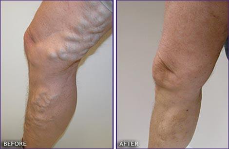 Varicose Veins Treatment In Nagercoil